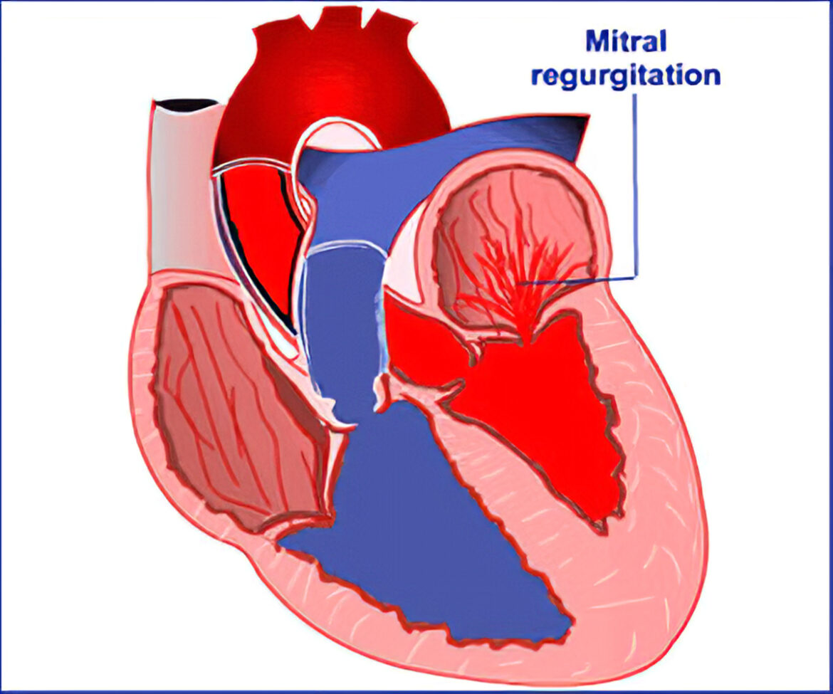 What Are The Complications With Mitral Regurgitation